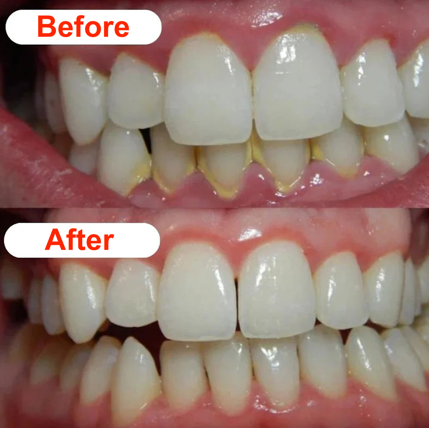 SP Dental Scaler