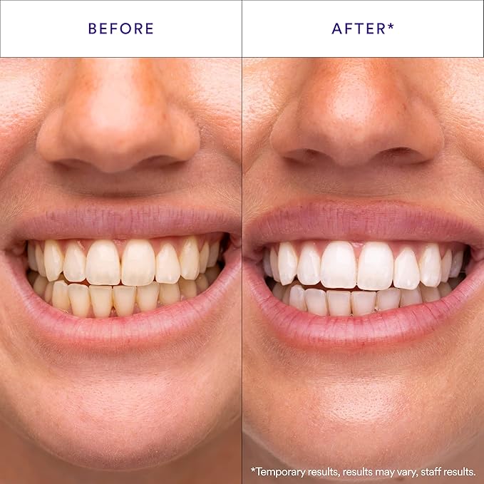 V34 Whitening Strips, Teeth Whitening Strips